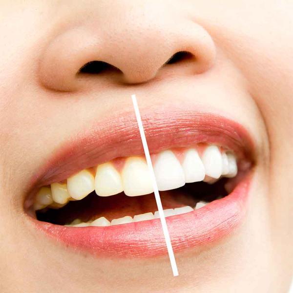 علت دندان های زرد چیست؟!